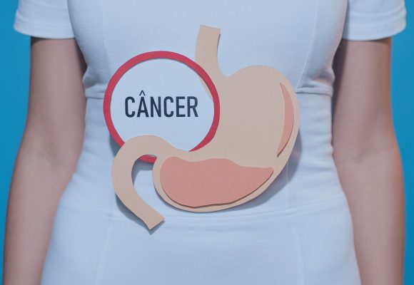 Câncer de Estômago – Tipos e Tratamento