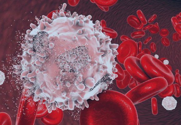 Leucemia: Conheça os Sintomas e tratamentos