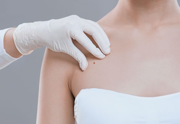 Sintomas de câncer de pele